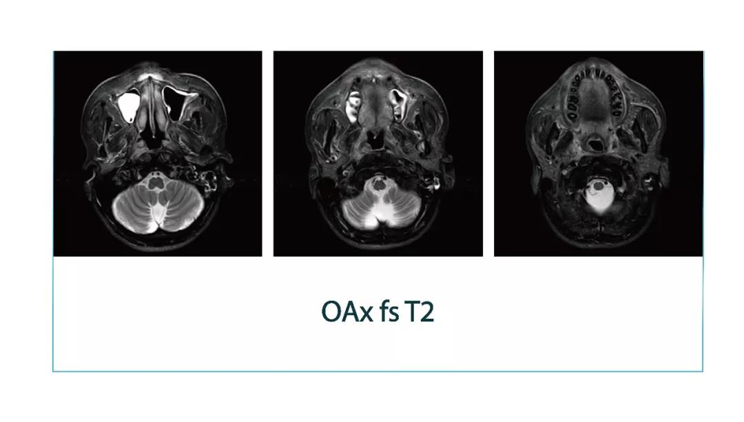 【朗润影像档案】磁共振影像病例分享(编号20180323)