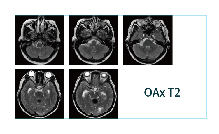 【朗润影像档案】磁共振影像病例分享(编号20190419)