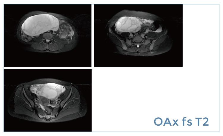 【朗润影像档案】磁共振影像病例分享(编号20190419)