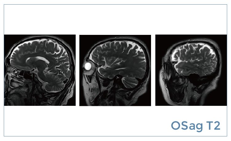 【朗润影像档案】磁共振影像病例分享(编号20190531)