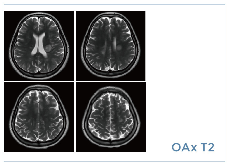 【朗润影像档案】磁共振影像病例分享(编号20190823)