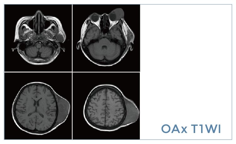 【朗润影像档案】磁共振影像病例分享(编号20190920)