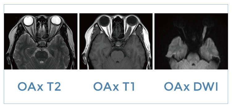 【朗润影像档案】磁共振影像病例分享(编号20191018)