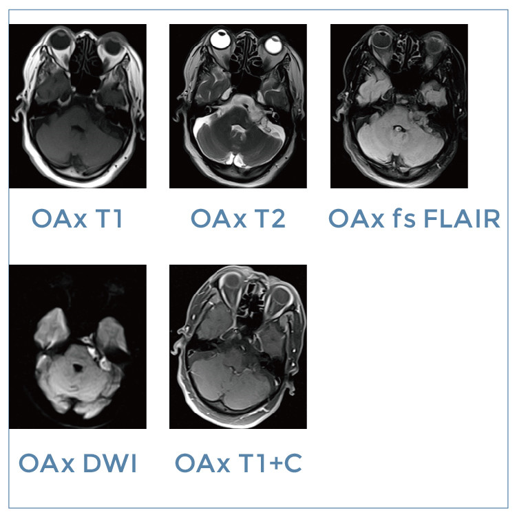 【朗润影像档案】磁共振影像病例分享(编号20191108)