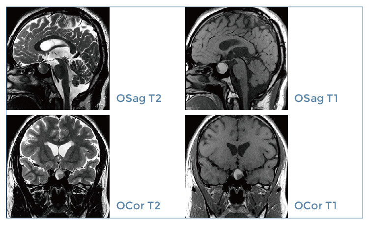 【朗润影像档案】磁共振影像病例分享(编号20191122)